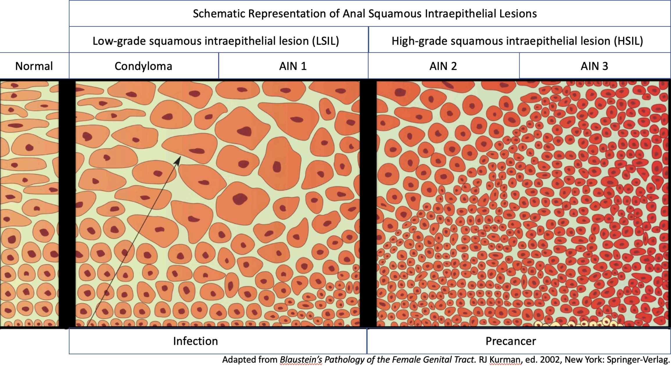 Schematic Representation of Anal Squamous Intraepithelial Lesions